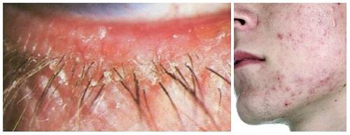 Чешется линия роста ресниц. Какие симптомы характерны для ресничного клеща