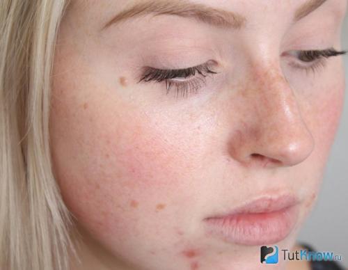 Мицеллярная вода химический состав. Нужна ли мицеллярная вода для лечения кожных недугов