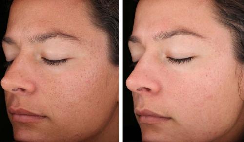 Зеленый морской пилинг от анна лотан. Рубиновый пилинг Анна Лотан – отзывы клиентов