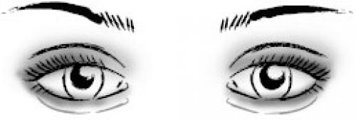 Как исправить выпуклые глаза. Выпуклые глаза теперь не проблема.