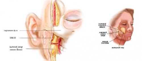 Комки Биша неудачные операции. Удаление Комков Биша. мой опыт.