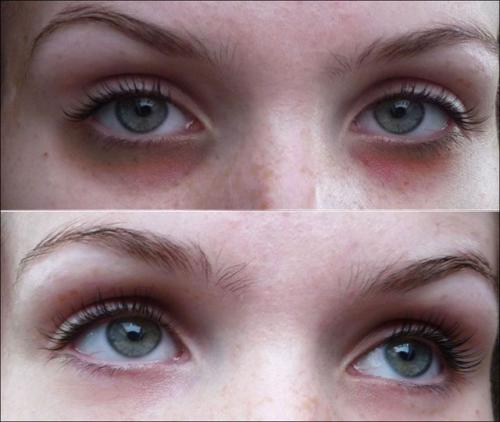 Как убрать мешки под глазами в 55 лет. Как быстро убрать или замаскировать мешки под глазами