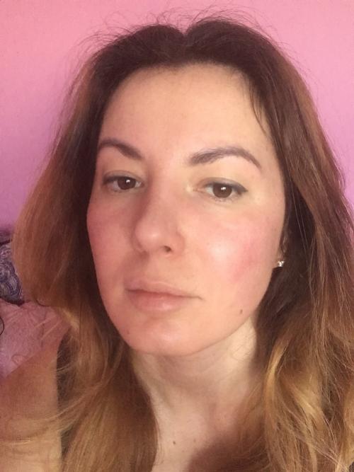 Комки Биша неудачные операции. Удаление Комков Биша. мой опыт.