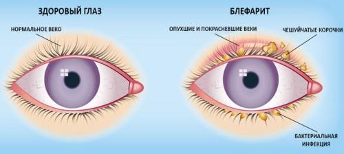 Тушь для чувствительных глаз. Причины аллергии на косметику для глаз