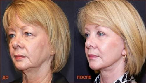 Коррекция лица уколами. Ботулинотерапия