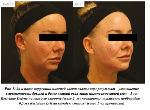 Коррекция формы лица филлерами. Третий этап: работа с предчелюстной зоной