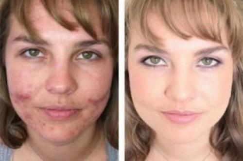 Как скрыть прыщи с помощью макияжа. Как замаскировать прыщи с помощью макияжа?