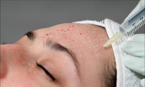 Четкий овал лица косметология. Обзор эффективных способов подтяжки овала лица: борьба с птозом и дряблостью кожи