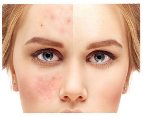 Как замаскировать прыщи консилером. Как правильно пользоваться консилером