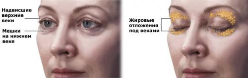 Нависшее веко косметология. Кому необходима подтяжка век