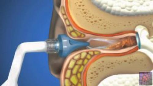 Как и чем правильно чистить уши. Как правильно чистить уши ребенку в домашних условиях – всё о чистке ушей детям