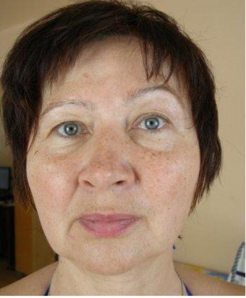 Виды асимметрии бровей. Причины асимметрии бровей