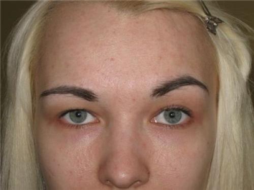 Виды асимметрии бровей. Причины асимметрии бровей