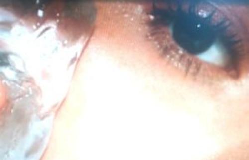 Как убрать нависшее веко скотчем. Как убрать нависшие веки под глазами