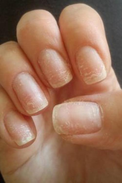 Почему не держится гель. Почему отслаивается гель-лак от ногтей: причины и особенности