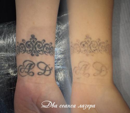 Лазерное удаление татуировок. Удаление тату: реально ли избавиться от рисунка полностью