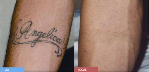 Лазерное удаление татуировок. Удаление тату: реально ли избавиться от рисунка полностью