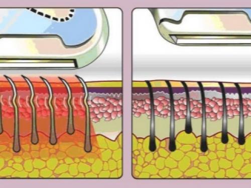 Мужская эпиляция в домашних условиях. Шугаринг 04