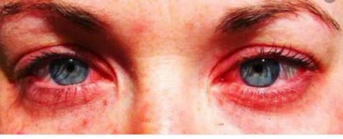 Аллергия на клей для ресниц у мастера симптомы. Как справится с аллергией на клей при наращивании ресничек