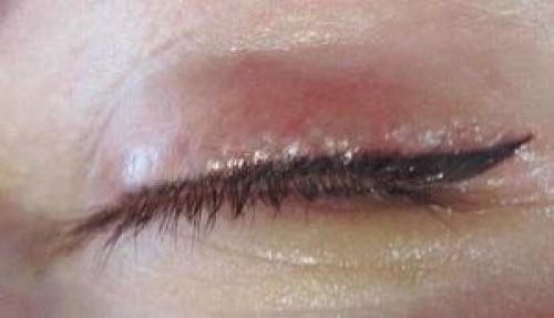 Сильный отек после татуажа бровей. Через сколько проходит отек?
