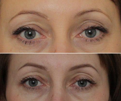 Сколько дней заживают брови после татуажа. Сколько времени и как долго проходит процесс заживления бровей после татуажа? 02