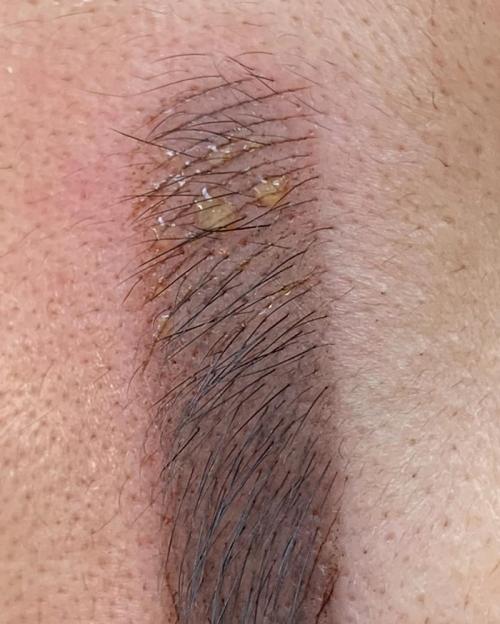 Какую мазь использовать после татуажа бровей. Чем мазать брови после татуажа