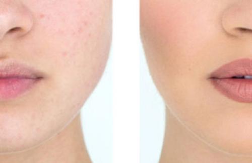 Кто пил алкоголь после татуажа. 