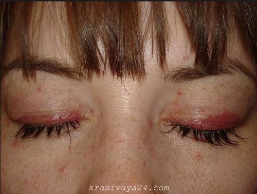 Офтальмологи о наращивании ресниц. Можно ли занести инфекцию при наращивании ресниц и какую?