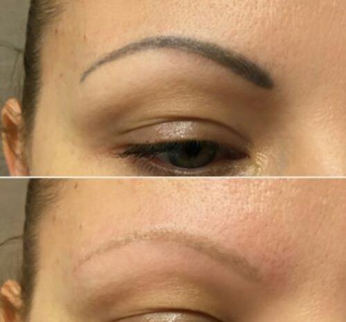 Противопоказания удаление татуажа. Сколько сеансов понадобится 02 Противопоказания удаление татуажа. Сколько сеансов понадобится 02