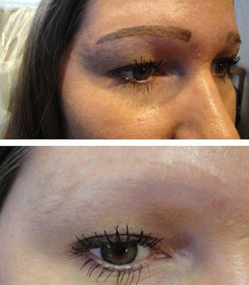 Ремувер для бровей, что такое. Удаление татуажа бровей ремувером: что необходимо знать о процедуре