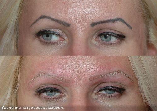 Кровоподтеки после лазерного удаления татуажа. Все про брови после удаление татуажа лазером: рекомендации косметолога