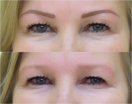 Кровоподтеки после лазерного удаления татуажа. Все про брови после удаление татуажа лазером: рекомендации косметолога