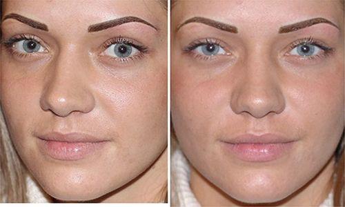 Ремувер для бровей, что такое. Удаление татуажа бровей ремувером: что необходимо знать о процедуре