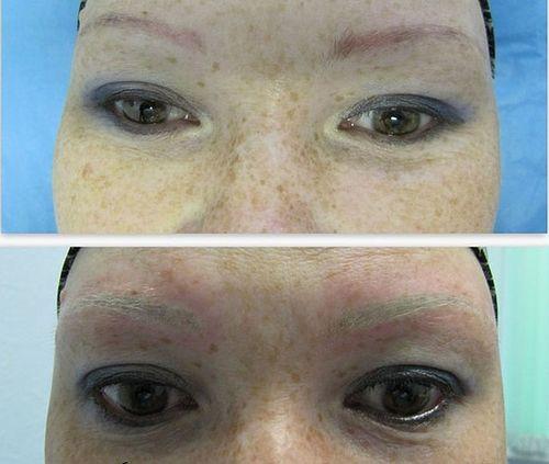 Ремувер для бровей, что такое. Удаление татуажа бровей ремувером: что необходимо знать о процедуре