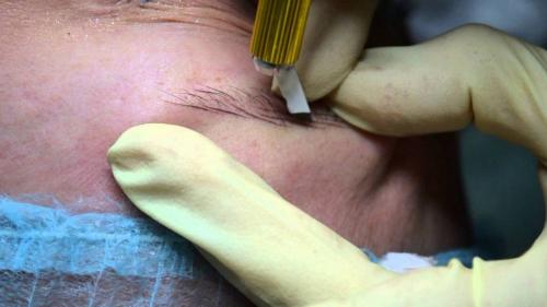 Брови после микроблейдинга по дням. ЧТО ТАКОЕ „МИКРОБЛЭЙДИНГ“?