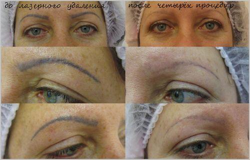 Ремувер для бровей, что такое. Удаление татуажа бровей ремувером: что необходимо знать о процедуре