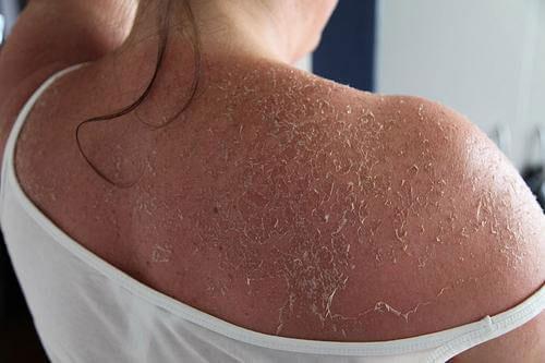 Шелушатся брови и крылья носа. Почему появляется шелушение?