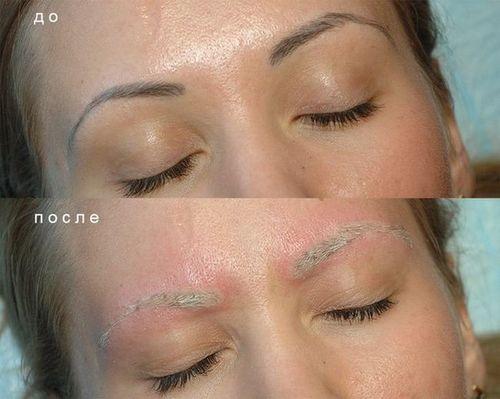 Ремувер для бровей, что такое. Удаление татуажа бровей ремувером: что необходимо знать о процедуре