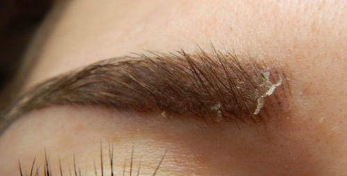 Противопоказания к микроблейдингу. Противопоказания для микроблейдинга бровей 02 Противопоказания к микроблейдингу. Противопоказания для микроблейдинга бровей 02