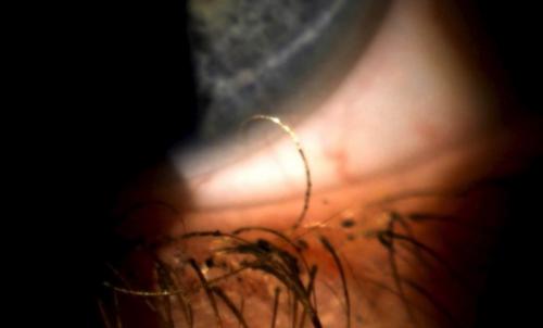 На нижнем веке не растут ресницы. Причины 04