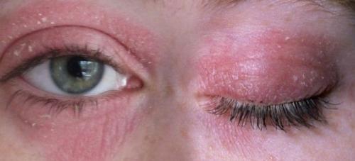 Как избежать аллергии при наращивании ресниц. Как справится с аллергией на клей при наращивании ресничек
