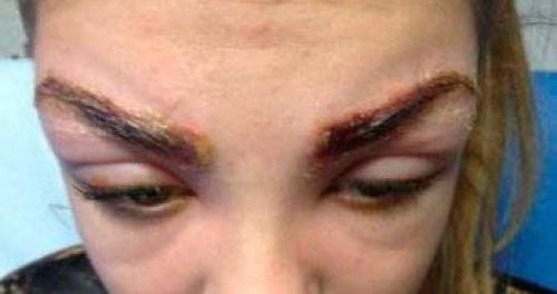 Отек глаз после татуажа глаз. Почему опухли глаза после татуажа век 02 Отек глаз после татуажа глаз. Почему опухли глаза после татуажа век 02