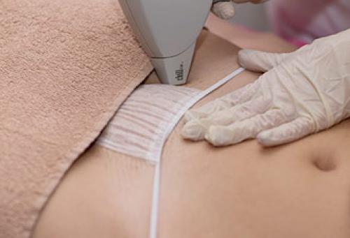 Лазерная эпиляция глубокое бикини это, как. Что такое лазерная эпиляция глубокое бикини 05 Лазерная эпиляция глубокое бикини это, как. Что такое лазерная эпиляция глубокое бикини 05