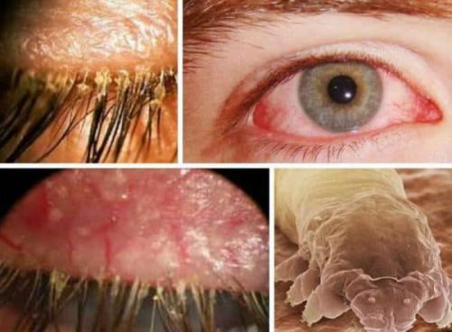 Ресницы выпали и не растут. Выпадение ресниц – почему выпадают у человека, причины