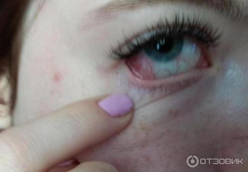 Суперклей попал в глаза 10 летней девочке