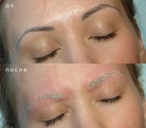 Как удалить татуаж с век. Решение проблемы при помощи лазера