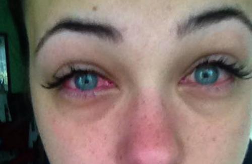 Гидрокортизон после наращивания ресниц. Лечение аллергии на нарощенные ресницы