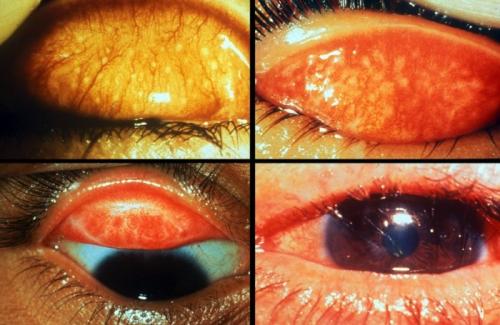 Уголки глаз наращивание. Что означает и какие особенности неполного наращивания ресниц 01 Уголки глаз наращивание. Что означает и какие особенности неполного наращивания ресниц 01