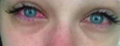 Воспаление верхнего века после наращивания ресниц. Основные причины зуда после наращивания