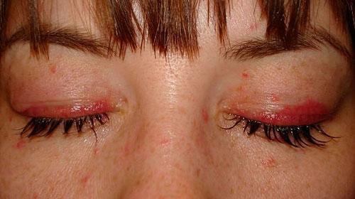 Ожог глаза после наращивания ресниц. Химический ожог слизистой глаза после наращивания ресниц